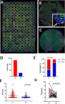 Homotypic cell-in-cell structures as an adverse prognostic predictor of hepatocellular carcinoma